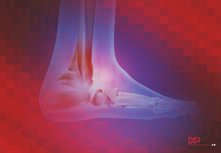 Fuß Implantate und Instrumente von digimed Medizintechnik Fuß Implantate und Instrumente von digimed Medizintechnik