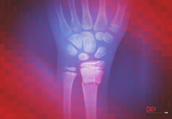 Unterelle Implantate und Instrumente von digimed Medizintechnik Unterarm Implantate und Instrumente von digimed Medizintechnik