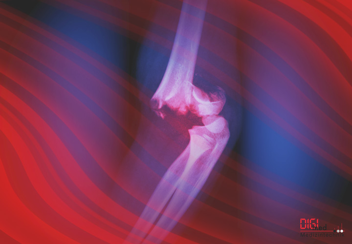 Unterschenkel Implantate und Instrumente von digimed Medizintechnik Unterschenkel Implantate und Instrumente von digimed Medizintechnik