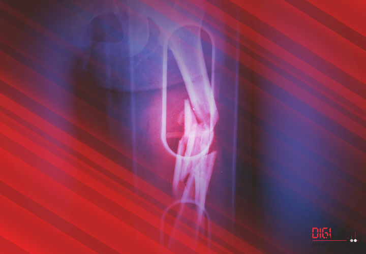 Oberarm Implantate und Instrumente von digimed Oberarm Implantate und Instrumente von digimed Medizintechnik