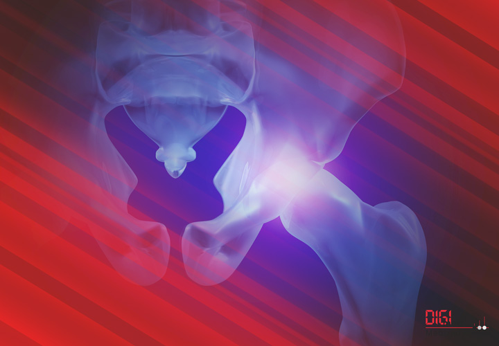 Becken Implantate und Instrumente von digimed Medizintechnik Becken Implantate und Instrumente von digimed Medizintechnik